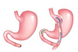 Gastric Bypass