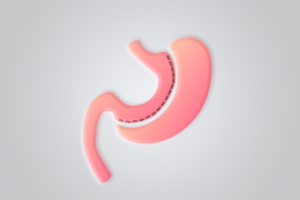 Gastric Sleeve