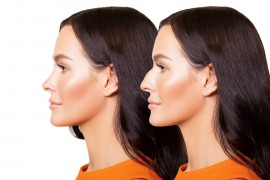 Rhinoplasty